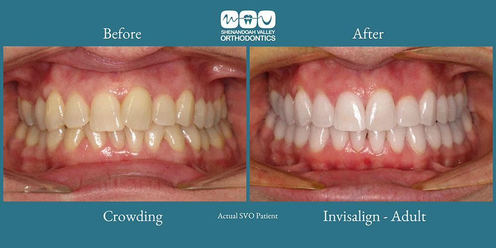 before and after image