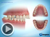 orverjet