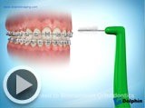brusing video